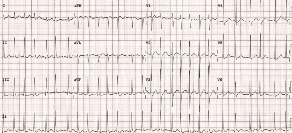 ECG showing atrial fibrillation with fast ventricular response
