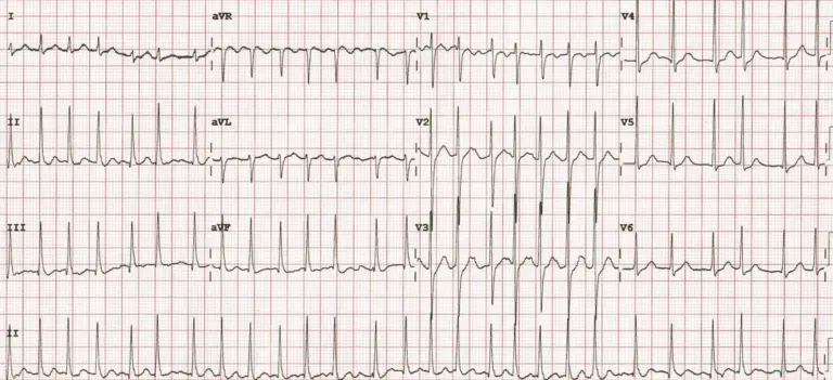 Atrial Fibrillation
