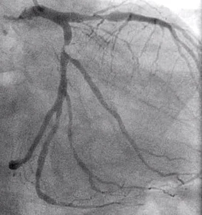 Angiogram showing coronary artery narrowing.