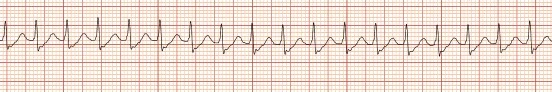 ECG strip showing supraventricular tachycardia