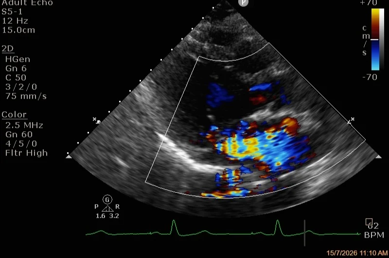 Echocardiogram showing significant mitral regurgitation